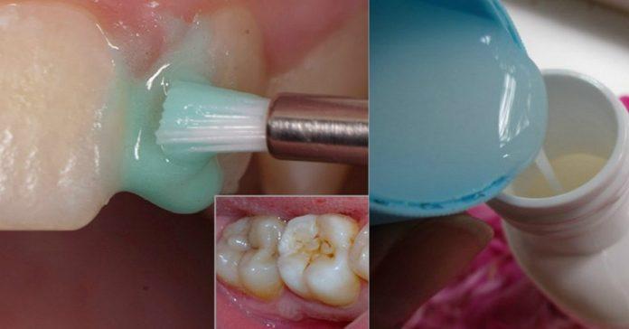Ատամների սպիտակեցում՝ տնային պայմաններում․ ավելի արդյունավետ քան պրոֆեսիոնալ սպիտակեցումը