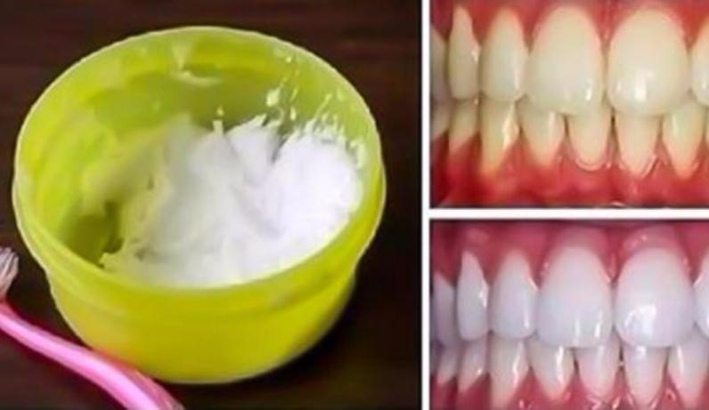 Ատամների սպիտակեցում՝ 3 րոպեում