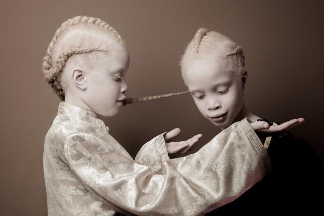 Уникальная особенность внешности этих близняшек покорила интернет