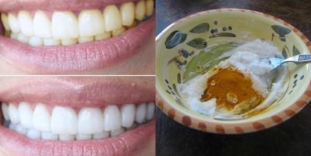 Ինչպե՞ս տնային պայմաններում սպիտակեցնել ատամենրը օգտագործելով ընդամենը 3 բաղադրիչ