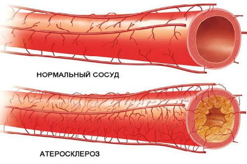 Способы чистки сосудов головного мозга в домашних условиях