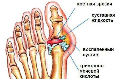 Как лечить отложение солей в суставах натуральными средствами