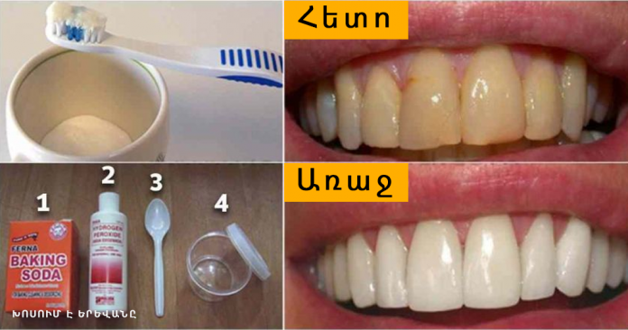 Ինչպես ազատվել ատամնափառից և սպիտակեցնել ատամներն առանց թանկարժեք պրոցեդուրաների
