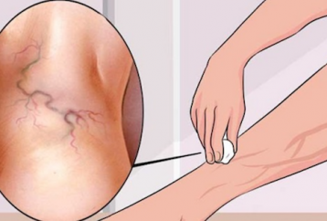 Get Rid of Varicose Veins Forever With The Use of One Simple Ingredient!
