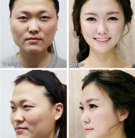 Նոր դեմքն այլեւս երազանք չէ. Մոխրոտ ստեղծելու պլաստիկ վիրաբուժության կորեական ֆաբրիկան