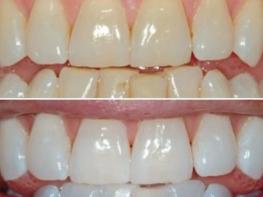 Ատամները սպիտակեցնելու ավանդական միջոց