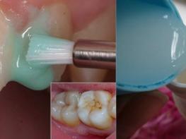 Ատամների սպիտակեցում՝ տնային պայմաններում․ ավելի արդյունավետ քան պրոֆեսիոնալ սպիտակեցումը