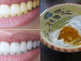 Ինչպե՞ս տնային պայմաններում սպիտակեցնել ատամենրը օգտագործելով ընդամենը 3 բաղադրիչ