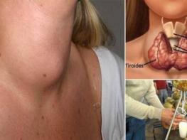Doctors Will Never Tell You This: Cure Your Thyroid Gland with Just One Ingredient!