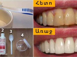 Ինչպես ազատվել ատամնափառից և սպիտակեցնել ատամներն առանց թանկարժեք պրոցեդուրաների