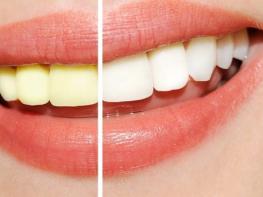 Այս կախարդական միջոցի շնորհիվ 1 շաբաթում ձեր ատամները կփայլեն. բնական այս միջոցը չունի բացասական ազդեցություններ