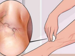 Get Rid of Varicose Veins Forever With The Use of One Simple Ingredient!