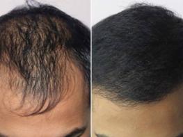 Վերականգնեք թափված մազերը՝ ընդամենը 2 բաղադրիչի օգնությամբ